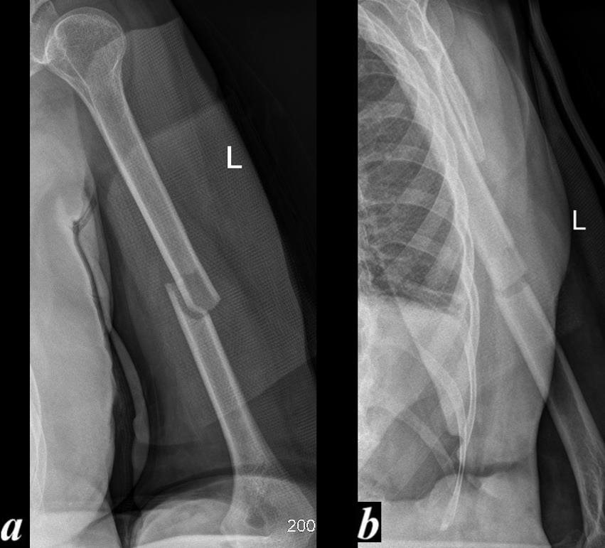 Description of Fractures | Bone Fractures