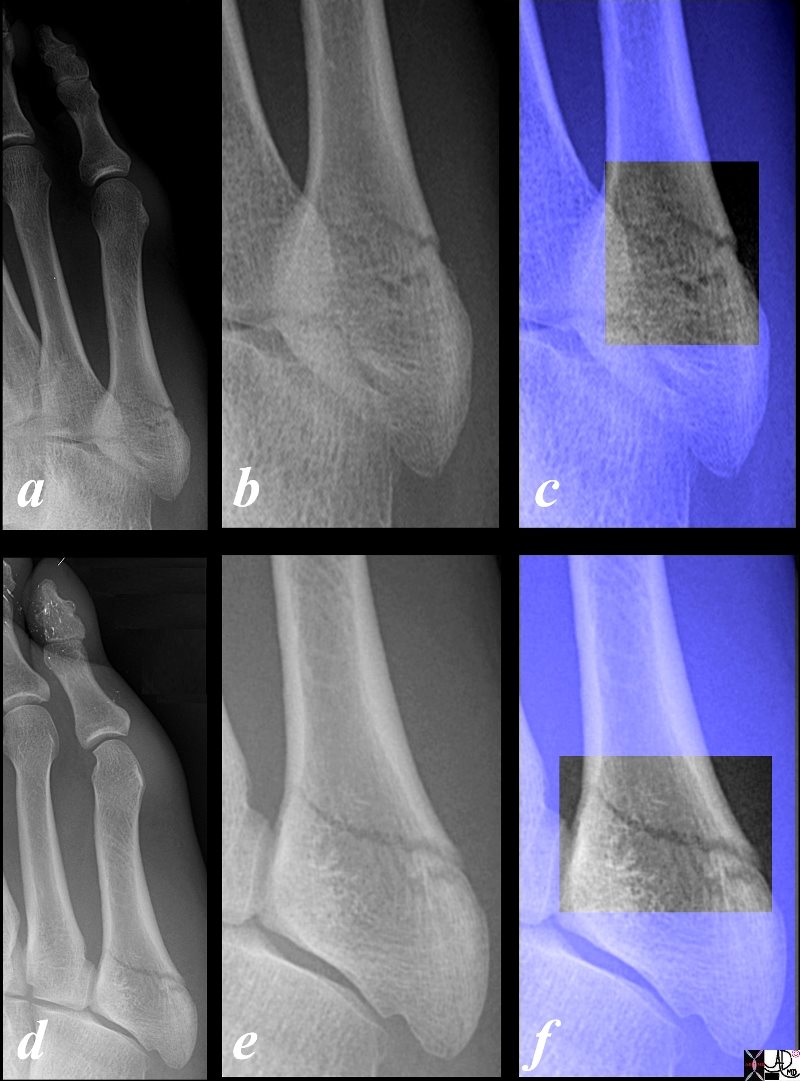 Description of Fractures | Bone Fractures